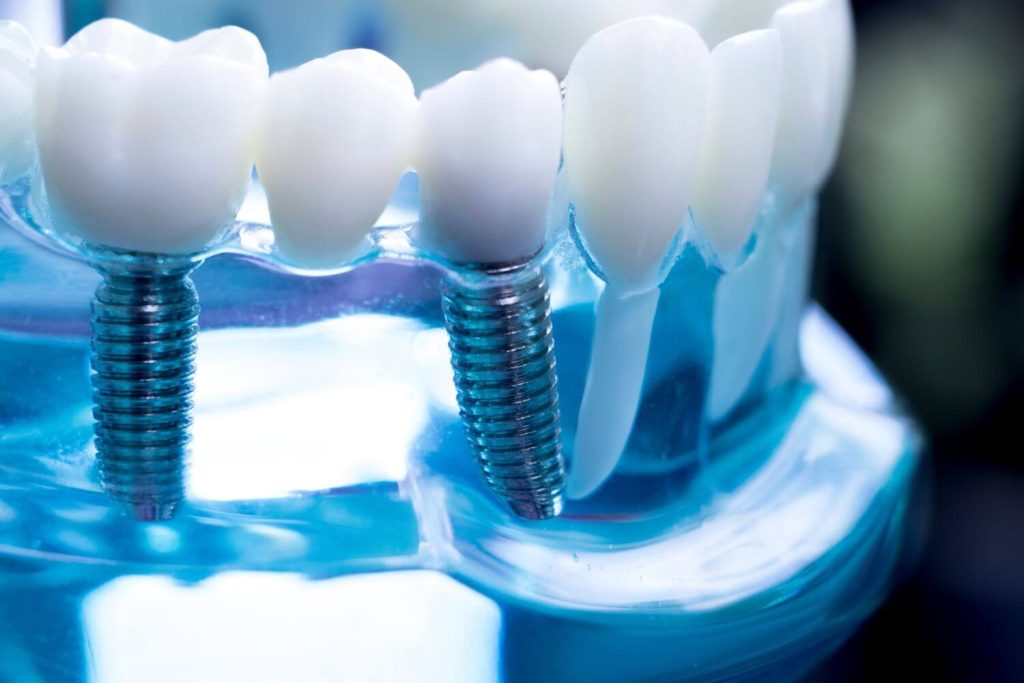 implantes dentales en Vigo